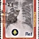 India on Tubercle Bacillus Discovery